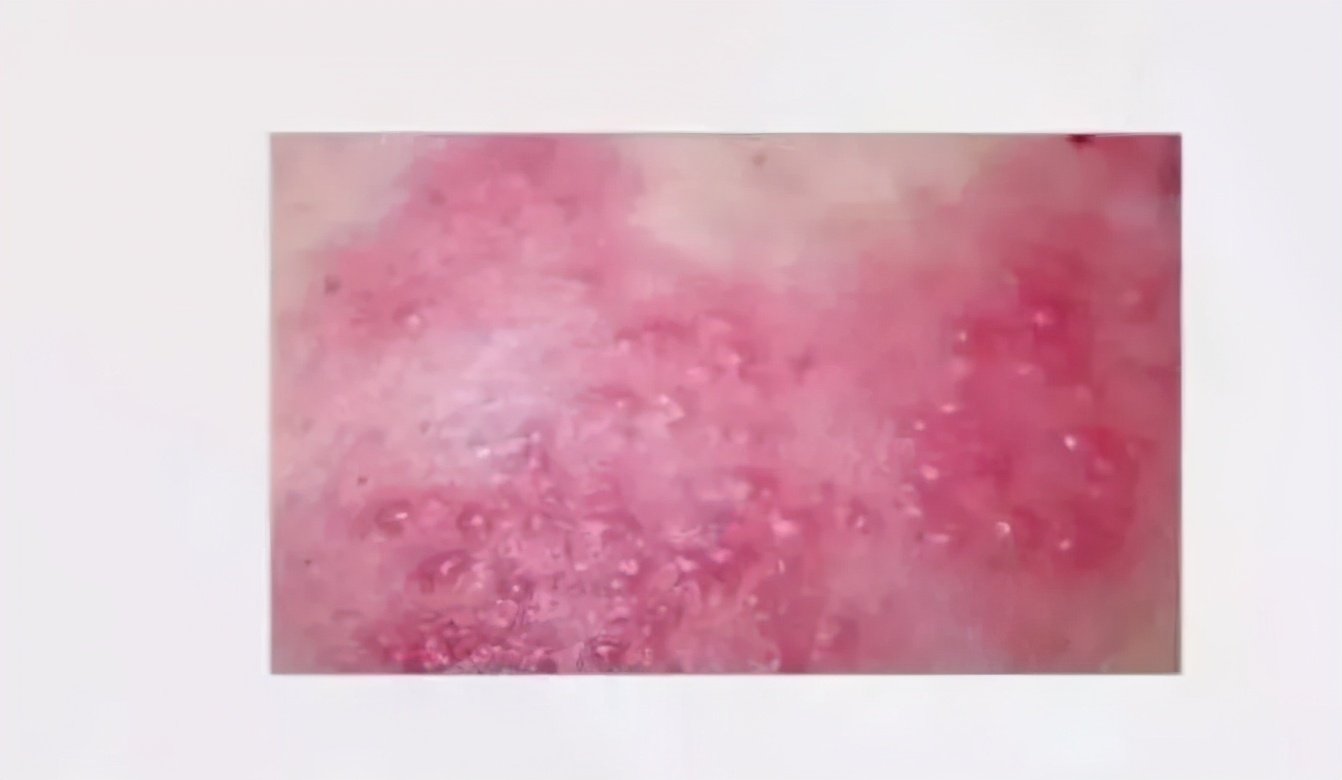 皮肤病反反复复要如何调理,皮肤病反反复复中药如何治疗