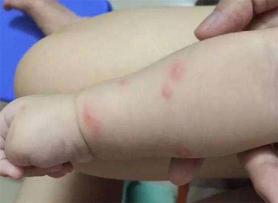 防蚊虫的小妙招家里有宝宝,帮助宝宝舒缓被蚊虫叮咬后的不适