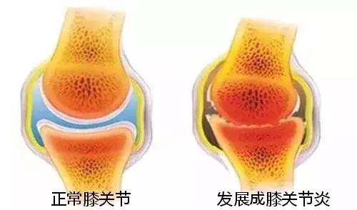 骨科专家膝关节炎十大误区,名医治疗膝关节炎经验方