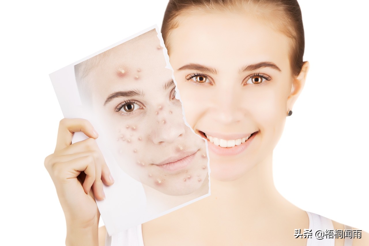 别乱用祛痘产品,祛痘妙招不要产品