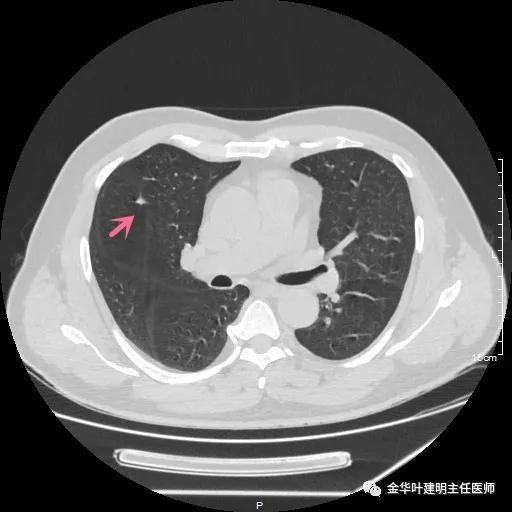 医者仁心过度治疗,肺实性结节多大需手术