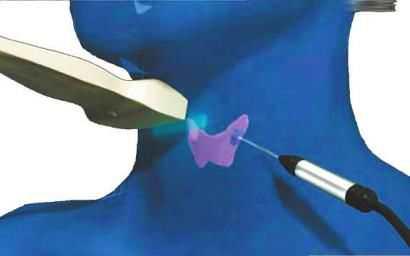 微创治疗甲状腺结节效果好吗,甲状腺结节消融与微创的区别