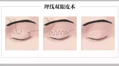 常见的几种双眼皮,常见双眼皮的手术方法及利弊