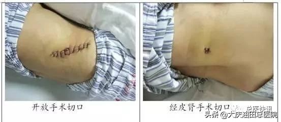 健康提醒:泌尿外科专家说,肾结石超0.6cm,就要及时治疗