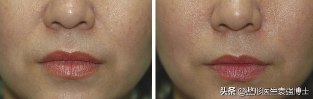 25岁有法令纹怎么改善,每天三分钟去掉法令纹的小技巧