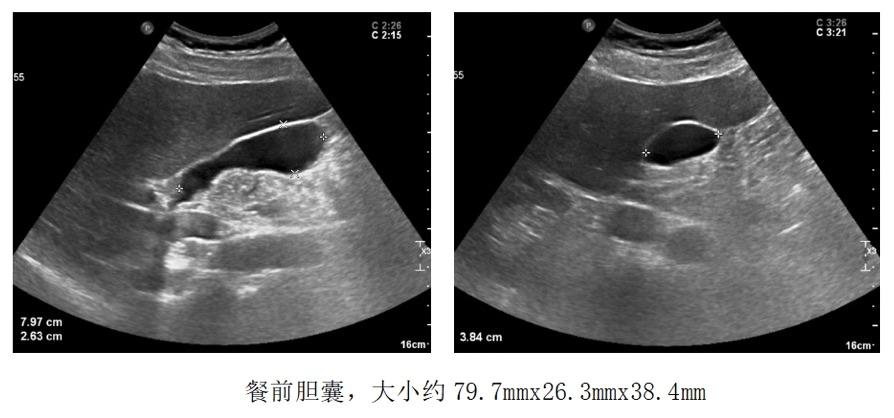 胆囊息肉消融保胆有效吗,胆囊息肉消融保胆有用吗