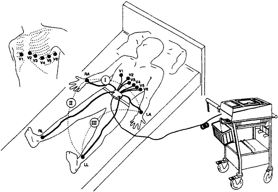 窦性心动过缓一度房室阻滞,心动过缓血压低是怎么回事