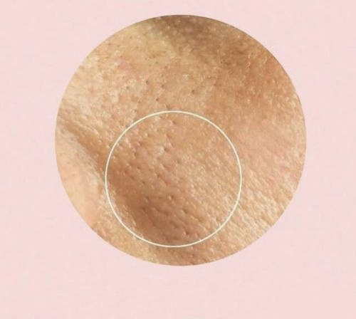 油皮毛孔大泛红怎么改善,干皮毛孔粗大怎么改善小妙招