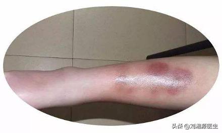 系统性血管炎怀孕能要吗,怀孕得了血管炎怎么办