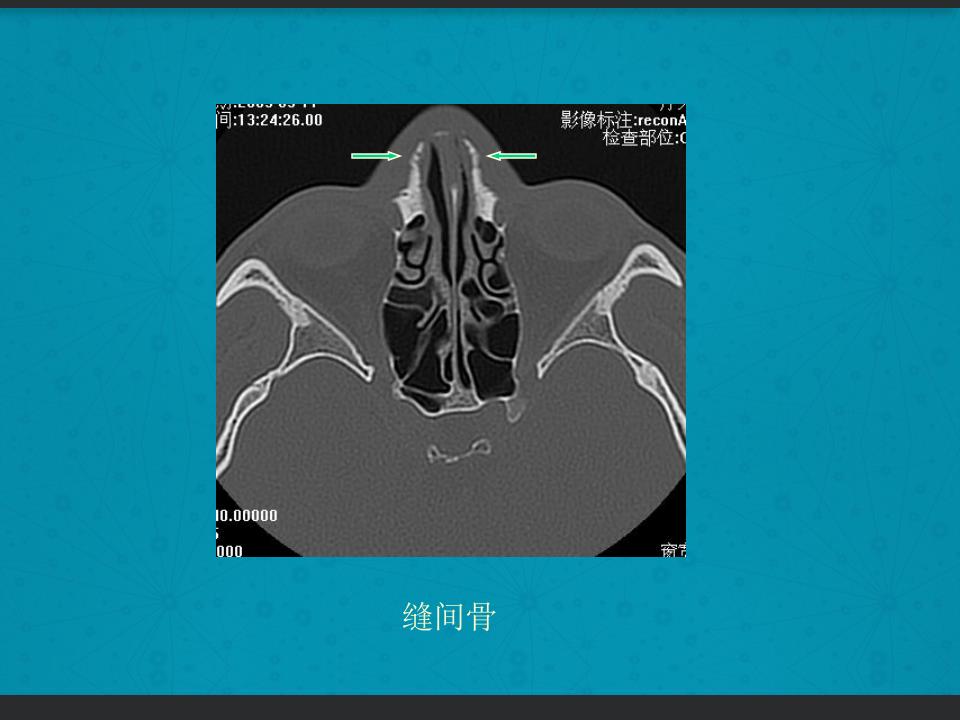 鼻骨骨折复位全过程,诊断证明鼻骨骨折问号是什么意思