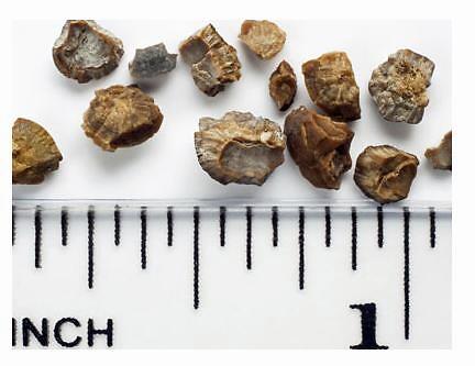 胆结石20mm怎么治好,胆结石6mm有多大需不需要手术