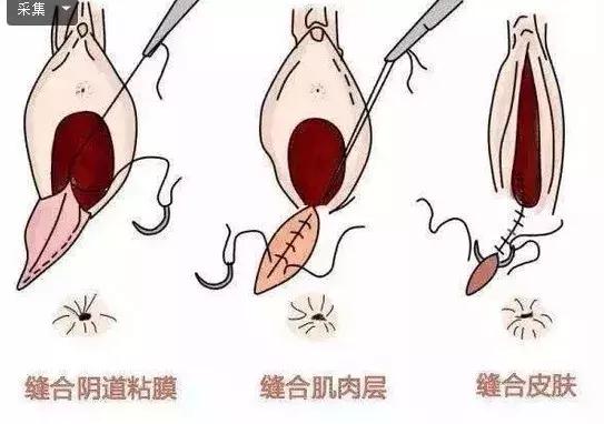 顺产挨的“那一刀”,还有多少女人心有余悸?