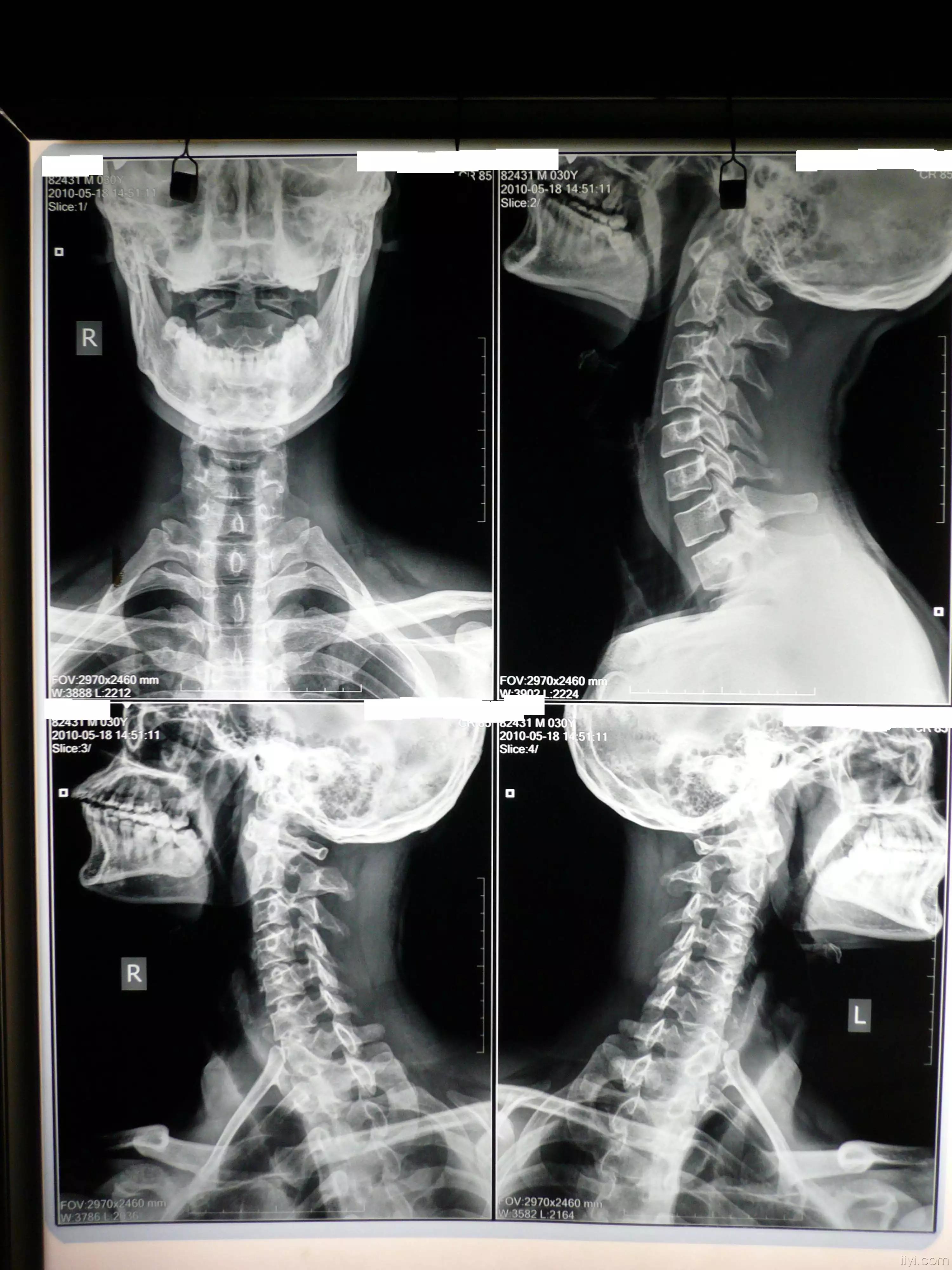 颈椎腰腿痛治疗手法,老中医治疗颈椎腰腿疼