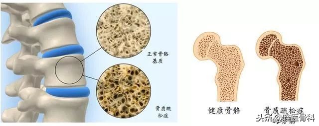 老年人的最后一次骨折,老年人请谨防人生最后一次骨折