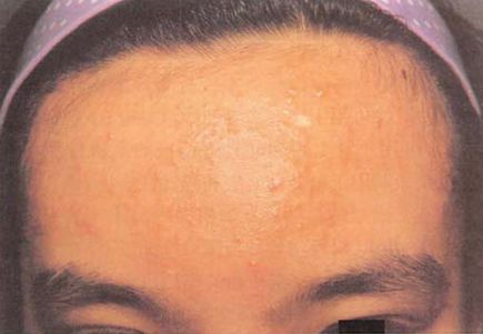 青春痘皮肤病如何治疗好,青春痘怎么治疗最好女学生