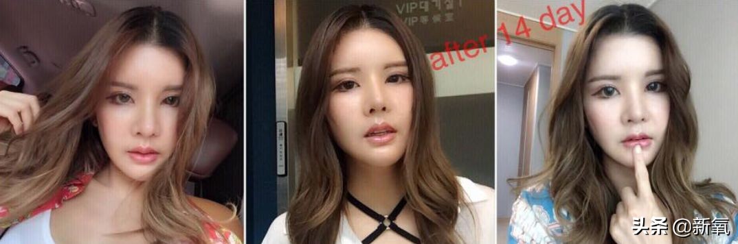 18岁土肥圆豪掷800万全身整形，鼻子6次大整假体穿出，效果却超美