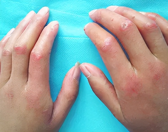 免疫性疾病皮肤症状,免疫系统引起的皮肤病严重吗