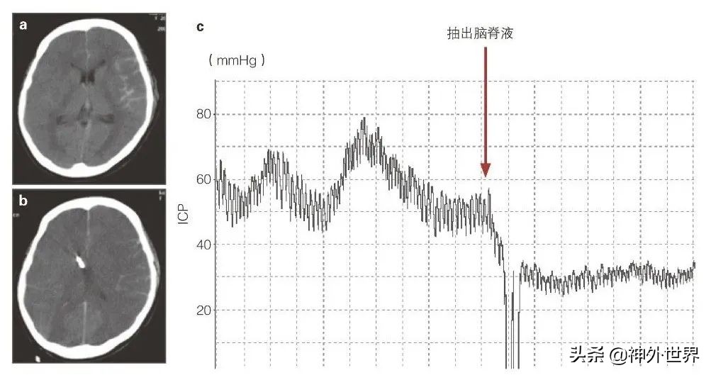 日本经验：脑外伤监测之颅内压监测