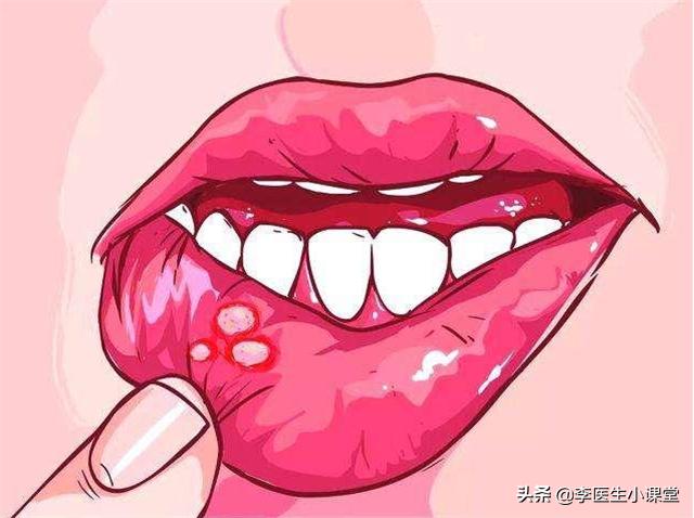 口腔溃疡起粉刺是缺维生素吗,口腔溃疡呈菜花状是什么病