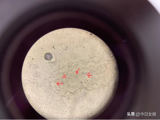 20岁男子双手脱皮还长了灰指甲，竟因爱抠脚的坏习惯！网友：细菌太厉害