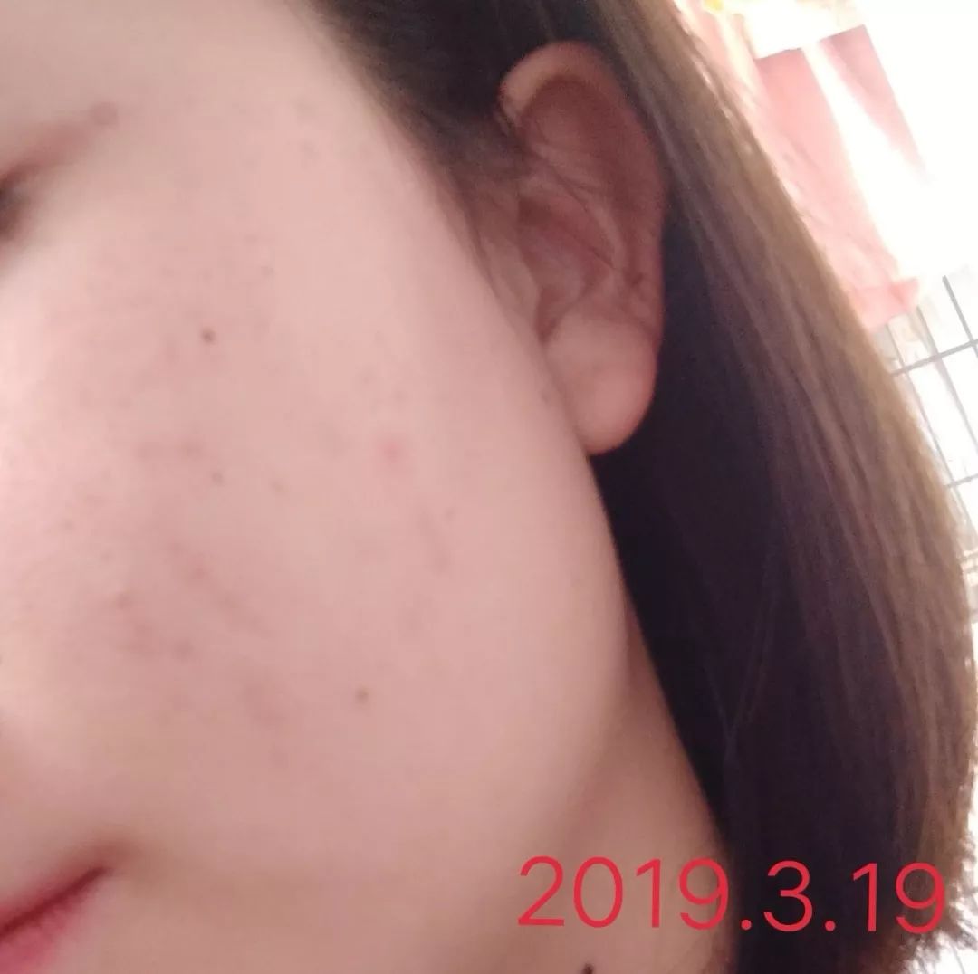 针对痘痘痘印的洗面奶,可以淡化痘印的洗面奶测评