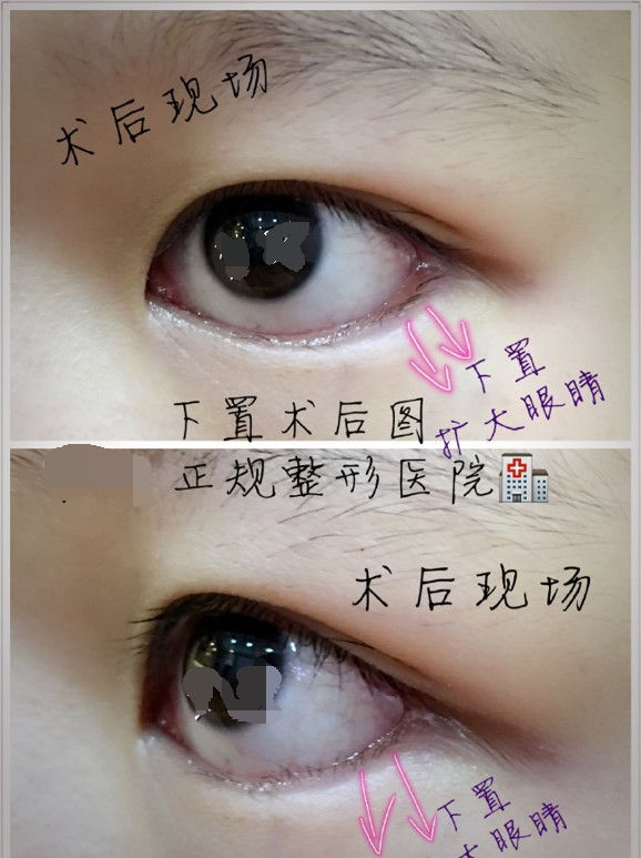下三白眼长大后会改善吗,下三白眼的人如何手术矫正