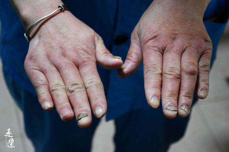 “第一次抠便，我差点吐了”！我和我的三百个爸妈