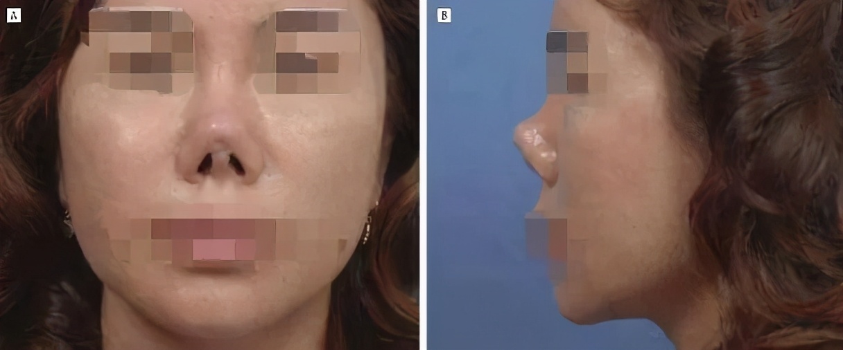 鼻头圆润鼻孔外露怎么改善,鼻孔外露土气怎么改善