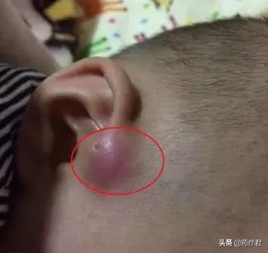 宝宝耳朵旁长小孔妈妈要正确应对,宝宝耳朵上有小孔需要手术吗