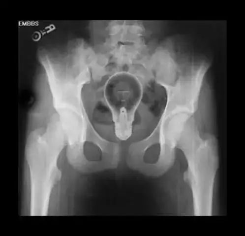 进去容易出来难：直肠异物，问题比“丢人”严重得多