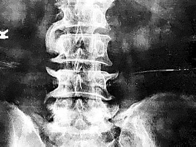 医生讲贴膏药可以治愈骨病,药品的宣传可以消除骨刺是真的吗