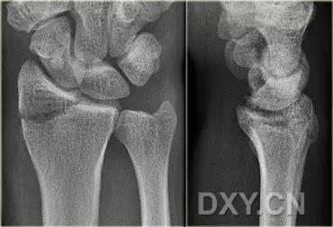 几种严重骨折医学名称,常见的骨折有哪些名称