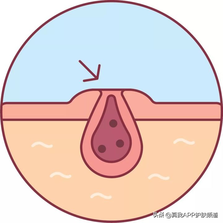 一张脸被泪沟毁了,一张痘脸如何从头开始修复