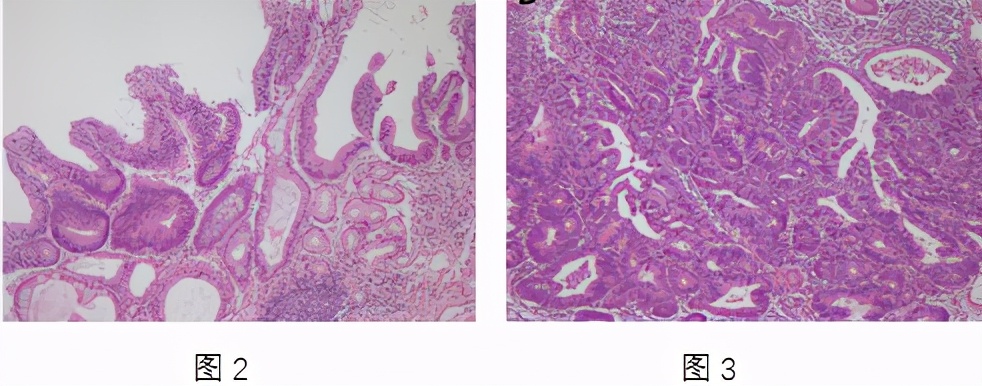 胃低级别上皮内瘤变该怎么办，到底是内镜随访还是行内镜切除？