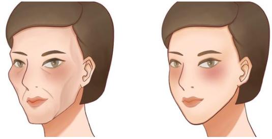 解决面部凹陷是什么原理,面部凹陷最好的解决方法