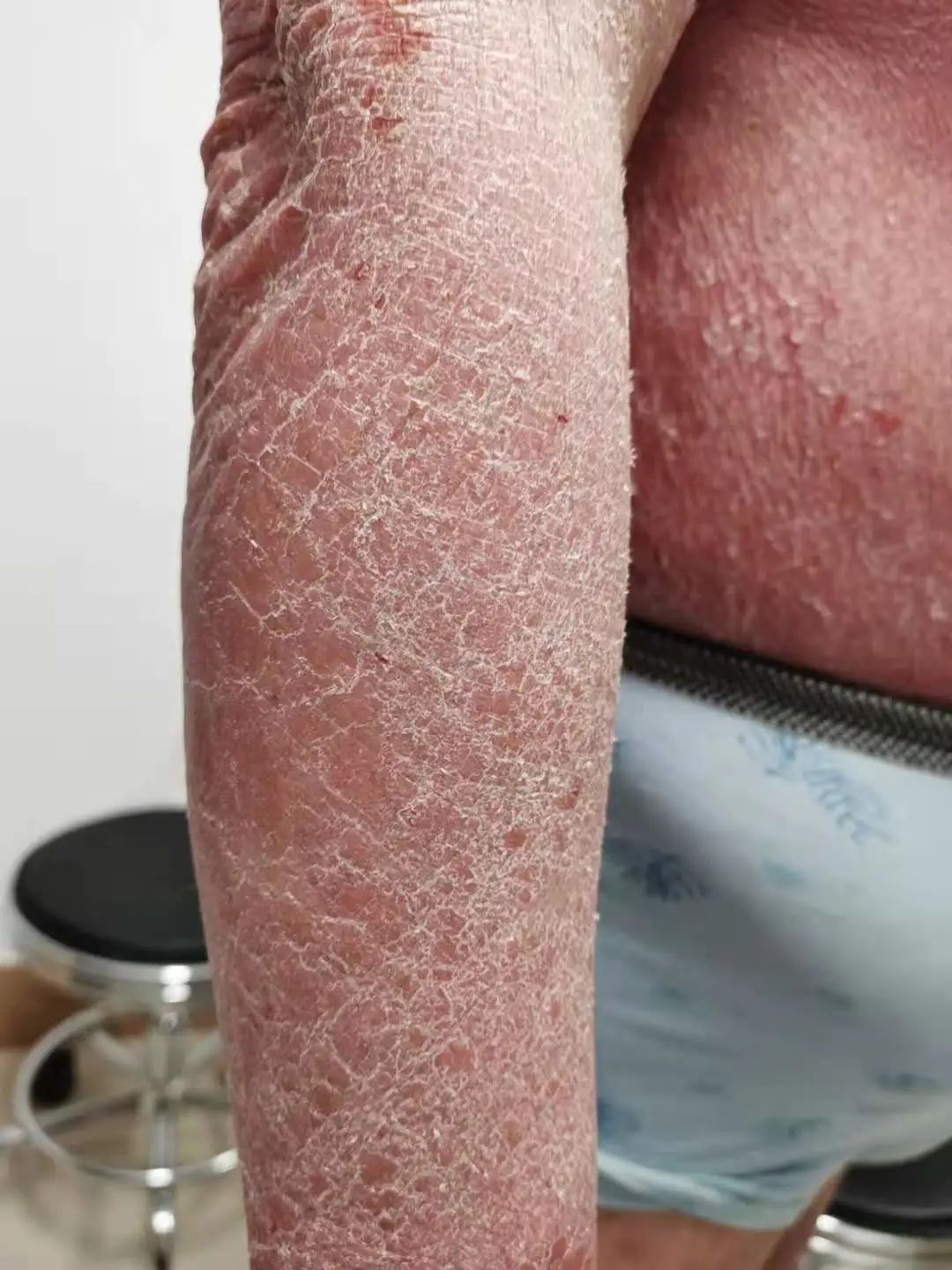 钱看没了，家也散了！都因为这个又掉“鳞”又掉“屑”的病