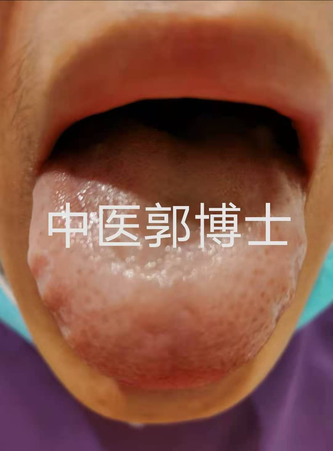 例假推迟轻微出血,例假推迟因为血不够