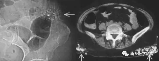 腹部平片能看到结石吗,腹部高密度结节影是什么