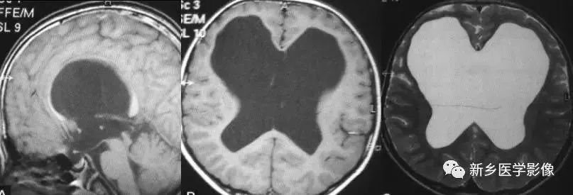脑室影像学表现,脑室占位影像