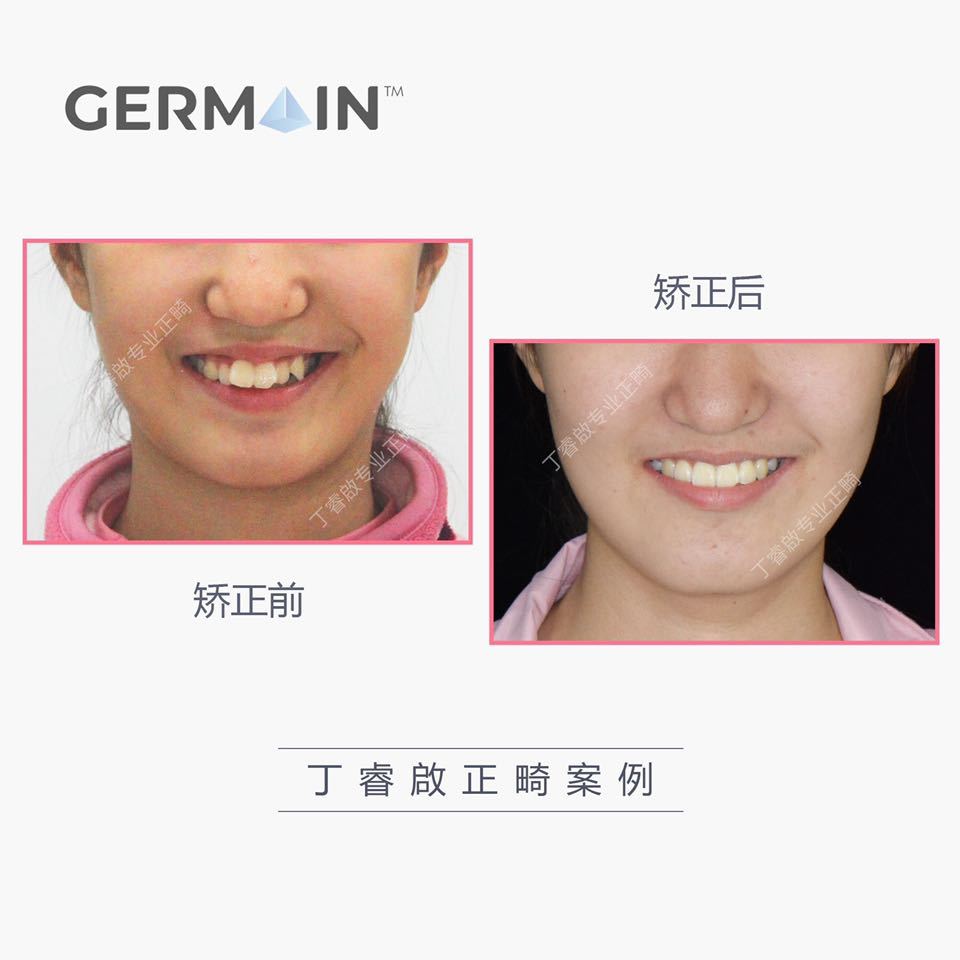郑州牙齿矫正丁睿啟|下巴后缩病例合集