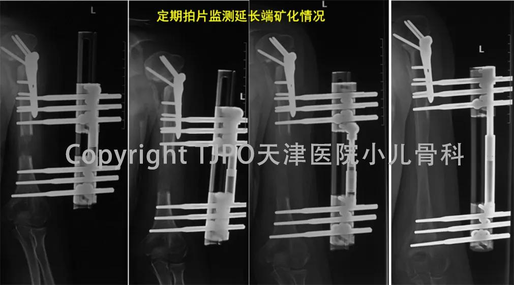 小儿骨科矫正足内翻,宝宝足内翻矫形支具