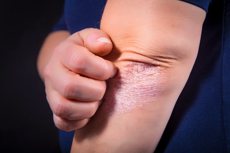 活在电线杆上的人：650万银屑病患者生存实录