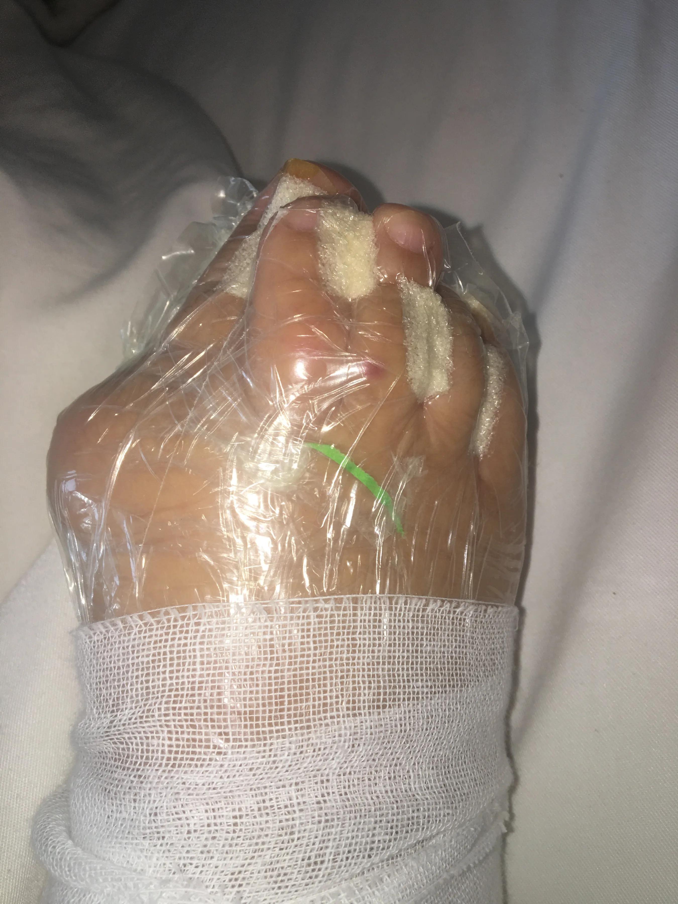 腰椎全麻手术的亲身经历,腰麻手术过程中是不是很可怕