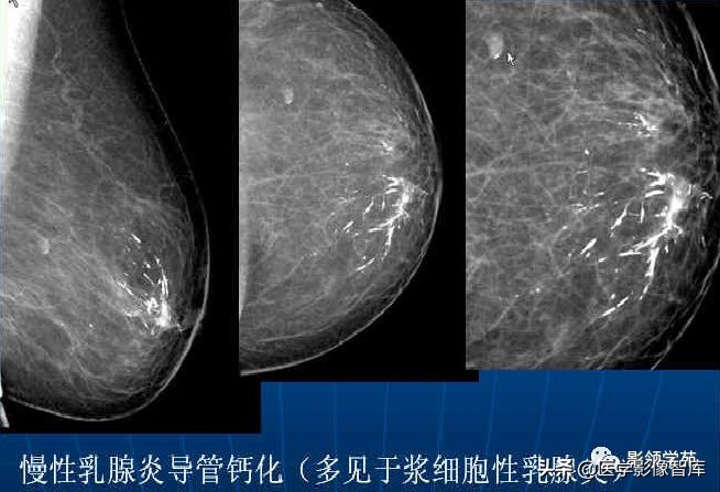 乳腺钙化怎么区分良性和恶性,乳腺钙化的诊断与分级