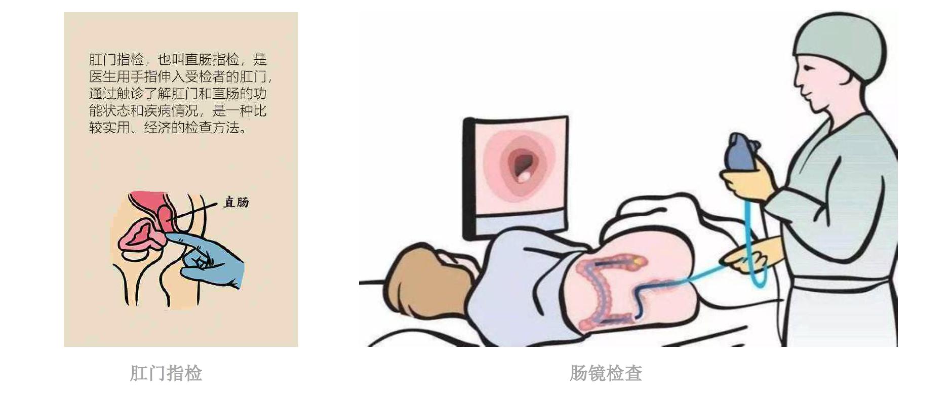 拉屎有血怎么判断是痔疮还是癌,有痔疮大便擦出血是肠癌吗