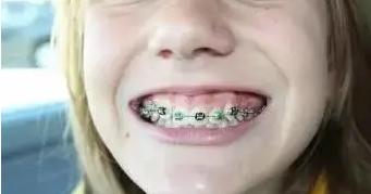 牙齿矫正最佳的黄金时期,牙齿矫正的黄金年龄段