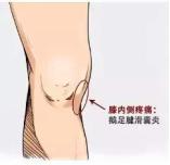 鹅趾肌腱滑囊炎还能跑步吗,跑步滑囊炎一般要休息多久