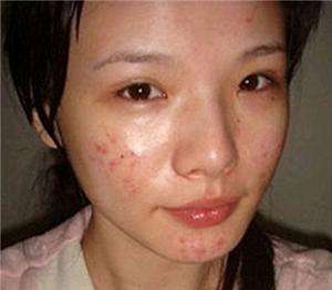 脸上长痘的位置分别代表什么,脸上不同部位长痘分别代表什么