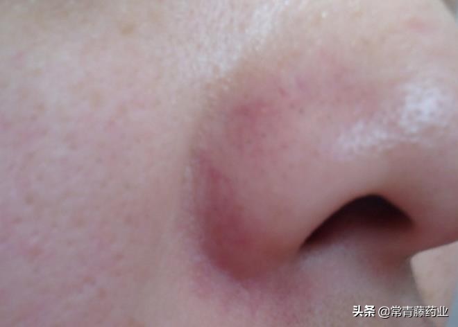 t区出油鼻翼两侧起皮是什么皮肤,鼻翼两侧泛红是脂溢性皮炎吗