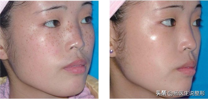 遗传雀斑激光祛斑最真实的经历,遗传性雀斑用激光祛斑的费用